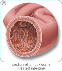 damage from hookworms in humans damage from hookworms in humans